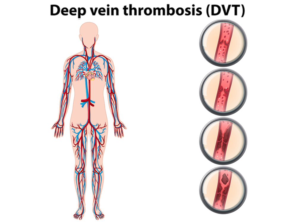 Deep vein thrombosis penis