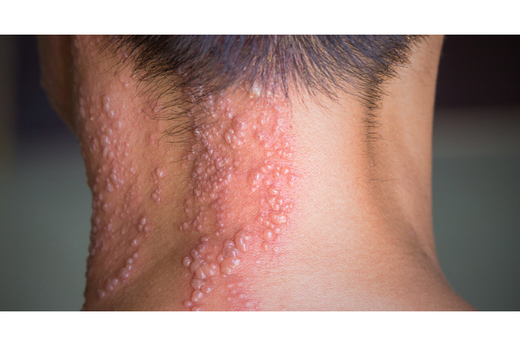 mitos dan fakta cacar api