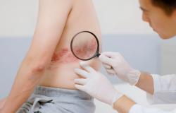 bahaya herpes zoster