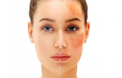 hiperpigmentasi kulit penyebab dan cara mengatasinya